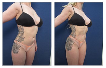 Waistline Narrowing with HD VASER lipo of abdomen, medial thighs, lateral thighs, flanks, lower back, upper back, arms, neck, chest, fat grafting to buttock and breasts