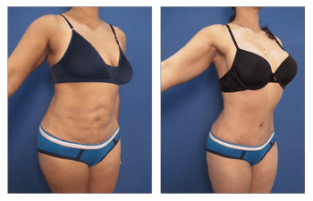 Waistline narrowing, Full tummy tuck with muscle aplication, breast augmentation