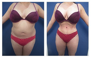 Waistline narrowing after HD VASER lipo and Renuvion Skin tightening of abdomen, back, flanks, axilla, neck, modified abdominal skin resection, lower body lift, fat grafting to buttock and breasts.
