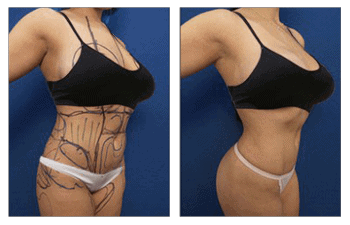 Waistline narrowing following Hi-Def VASER Lipo of abdomen, back, medial and lateral thighs, BBL, Breast lift with augmentation