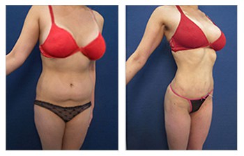 Waistline narrowing following High definition liposuction with VASER and Renuvion skin tighteninc of the abdomen, back, flanks, arms, medial thighs, and fat transfer to buttocks.