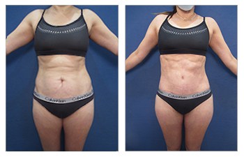 liposuction results:  before and after image
