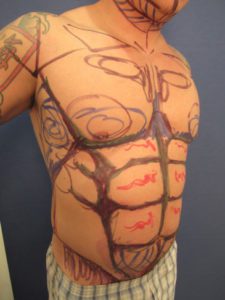 Our male patient demonstrating typical male abdomninal muscle preoperative markings used to guide abdominal etching