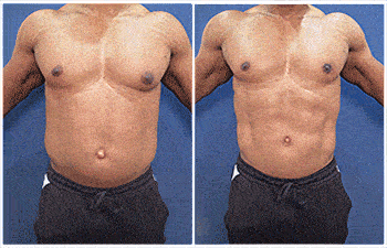 Abdominal Etching cost determined at your consultation