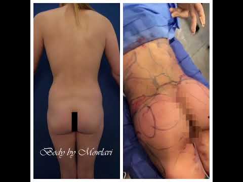 Patient's buttock improvmeent immediately following BBL surgery.