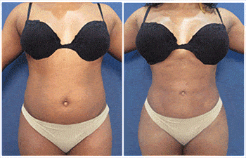 Back Contouring with High Definition Liposuction