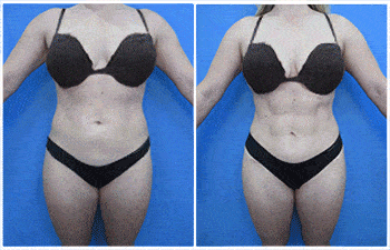 Female Abdominal Etching - High Definition Liposuction