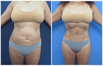 Revision body Contouring Complication with High Definition Liposuction
