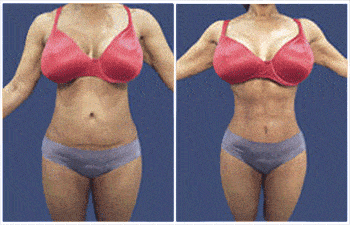 Revision body contouring using High Definition Liposuction