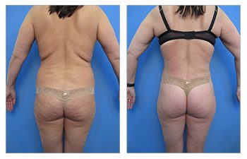 Back Liposucion Before and after Case 1