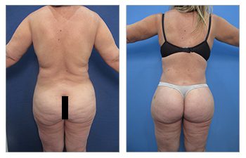 Back Liposuction Before and After Case 3