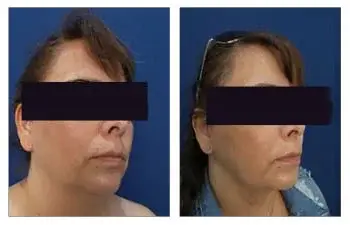 Chin and neck contouring