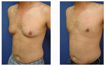 Optimized Chest appearance with gynecomastia repair