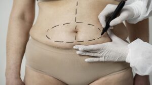 What is high definition liposuction
