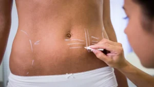 Can Liposuction Cause Adhesions?