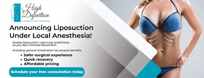 Banner announcing high definition liposuction under local anesthesia with an image of a woman in athletic wear, showcasing the torso area. The text highlights benefits including a safer experience, quick recovery, and affordable pricing.